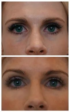 Eyes fillers treatment before after | RO Aesthetics in Holladay, UT