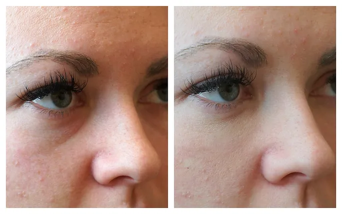 Eyes fillers treatment before after | RO Aesthetics in Holladay, UT