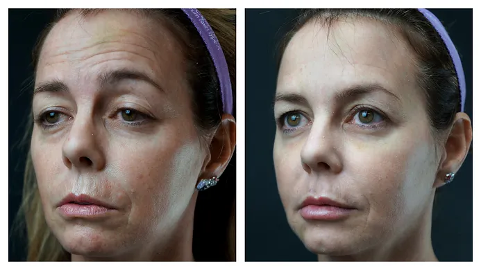 Botox treatment before after | RO Aesthetics in Holladay, UT