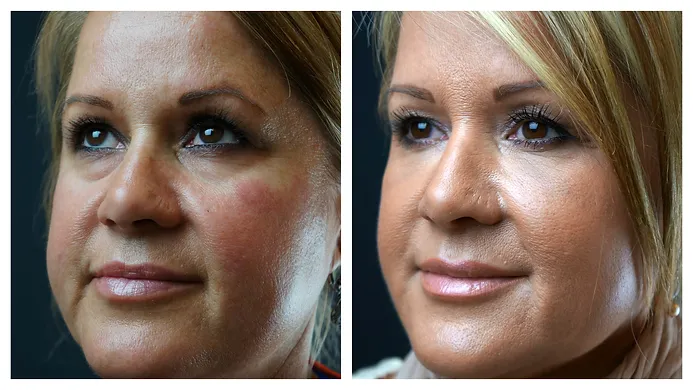 Botox treatment before after | RO Aesthetics in Holladay, UT