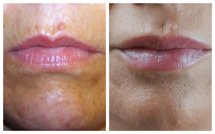Lip-Plump before after HA-based fillers | RO Aesthetics in Holladay, UT