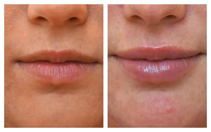 Lip-Plump before after HA-based fillers | RO Aesthetics in Holladay, UT