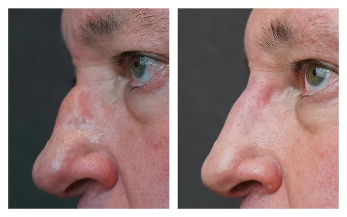 Nose fillers treatment before after | RO Aesthetics in Holladay, UT